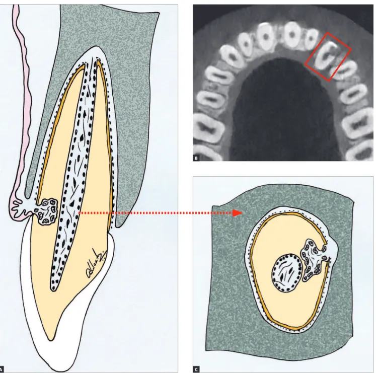 Figure 2 - External cervical resorption schematically shown (A and C), from tomographic slices (B)