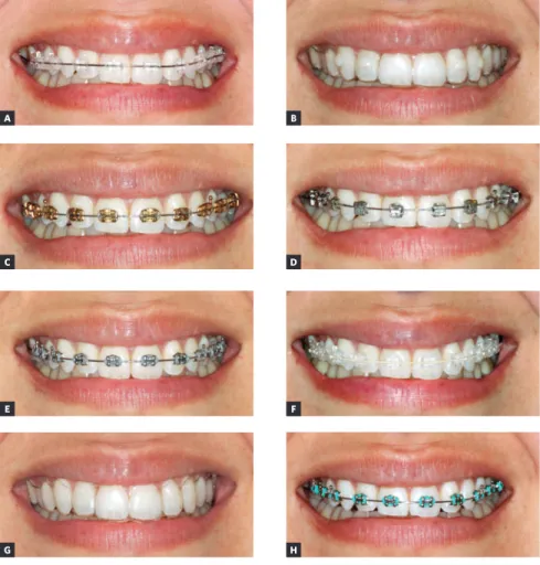 Figure 1 - Images used for attractiveness evalu- evalu-ation (photographic sheet): A) sapphire esthetic  brackets with stainless steel archwire; B) clear  tray aligner with attachments; C) golden  orth-odontic brackets; D) metallic self-ligating system; 