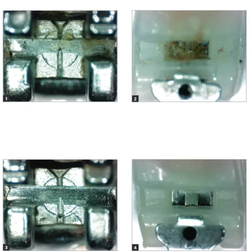 Figure 2 - Self-ligating bracket after clinical use  not subjected to prophylaxis with air-powder  polishing.