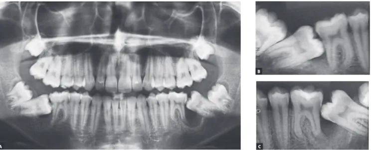Figure 4 - Initial radiographic aspect: panoramic radiograph (A) and periapical radiographs of teeth #46 and #47 (B), and #36 and #37 (C).