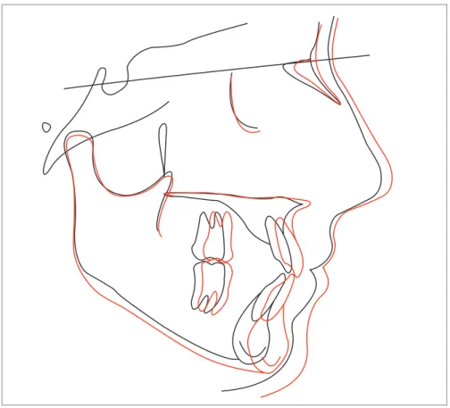 Figure 9 - Superimposition of initial (black) and final (red) cephalometric tracings.
