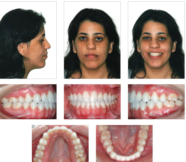 Figure 13 - Extra and intraoral photographs 6 years after treatment.