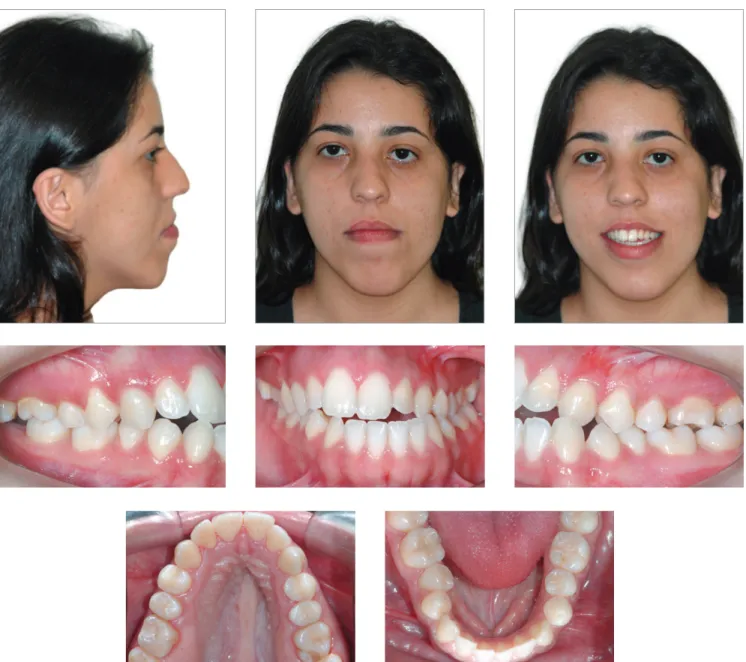 Figure 1 - Initial extra and intraoral photographs.