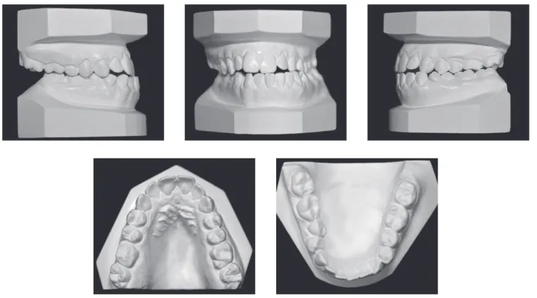 Figure 2 - Initial orthodontic study casts.