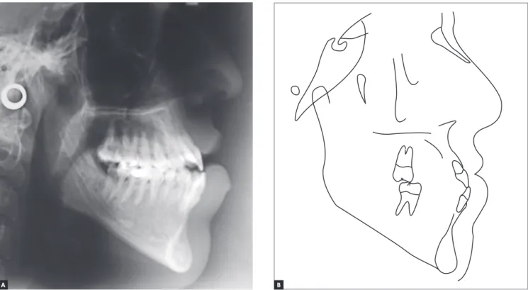 Figure 4 - Initial cephalograms in lateral view (A) and cephalometric tracing (B).