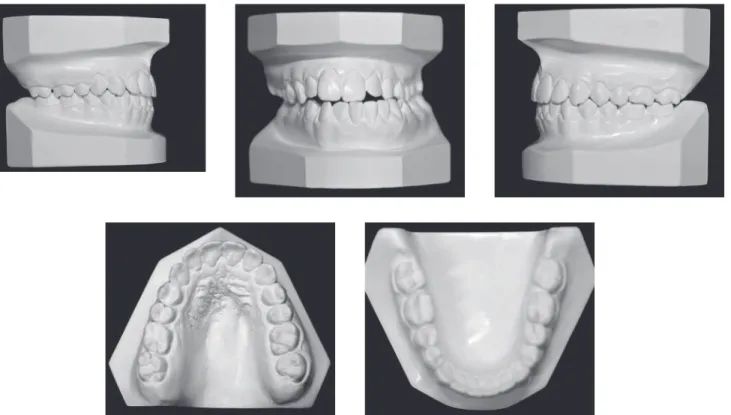 Figure 9 - Final orthodontic study casts.