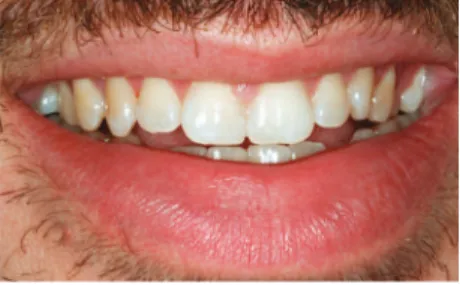 Figure 21 - Close-up smiling photograph with in- in-termaxillary fixation.