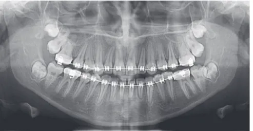 Figure 3 - Panoramic and lateral radiographs showing the orthodontic appliance used in previous treatment.