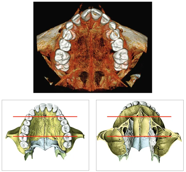 Figure 1 - Midpalatal suture and its three segments (anterior, middle and posterior) which are relative to other structures, for instance, the  transverse palatine suture, and nasal bones.
