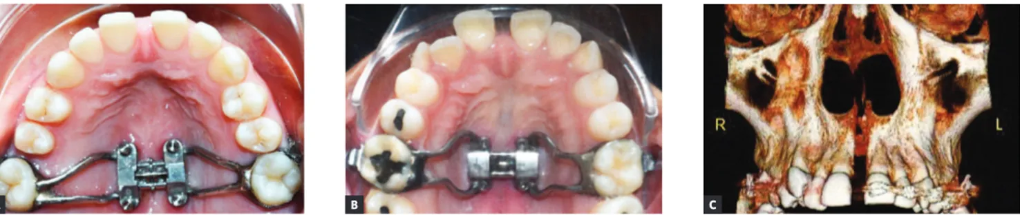 Figure 3 - MARPE appliance in which miniscrews are incorporated to the screw support design, with measures determined on the basis of morphology  of the palatal region parallel to the midpalatal suture: A) MSE expansion appliance (maxillary skeletal expand
