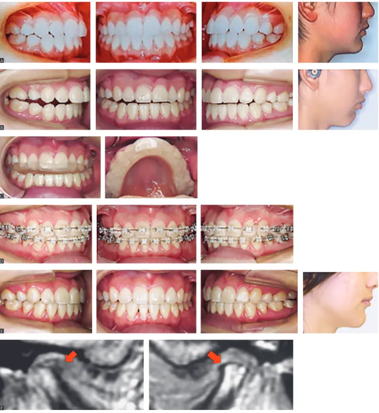 Figure 2 - A treatment case with open bite accompanied by osteoarthritis of the temporomandibular joint