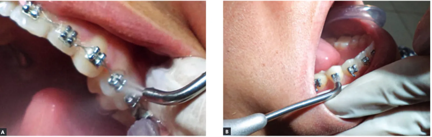 Figure 1 - Intraoral view of prophylaxis by air-powder polishing at an angle of 90° relative to the bracket surface in the maxilla (A) and mandible (B).