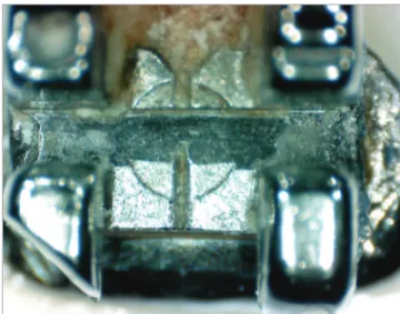 Figure 3 - Bracket after clinical use subjected to prophylaxis by air-powder  polishing.