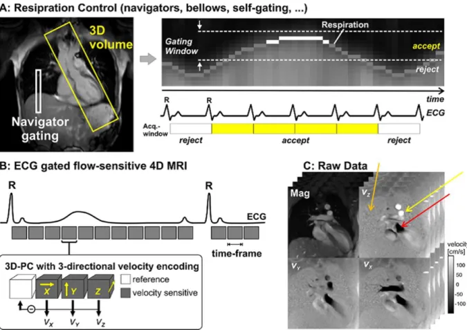 Figure 1.6 A: Data acquisition for 3D cine velocity acquisition using navigator gating for respiration control