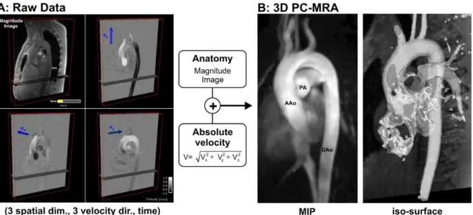 Figure  1.7  Image  processing  for  obtaining  a  3D  PC-MRA  of  a  healthy  thoracic  aorta