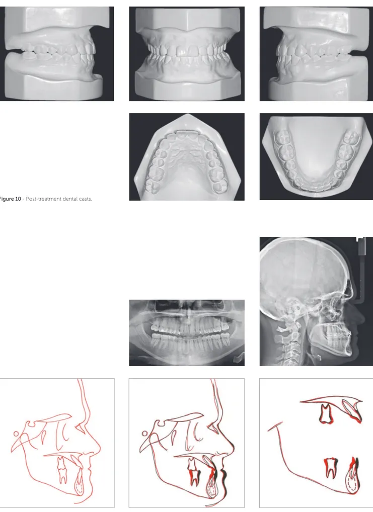 Figure 10 - Post-treatment dental casts.