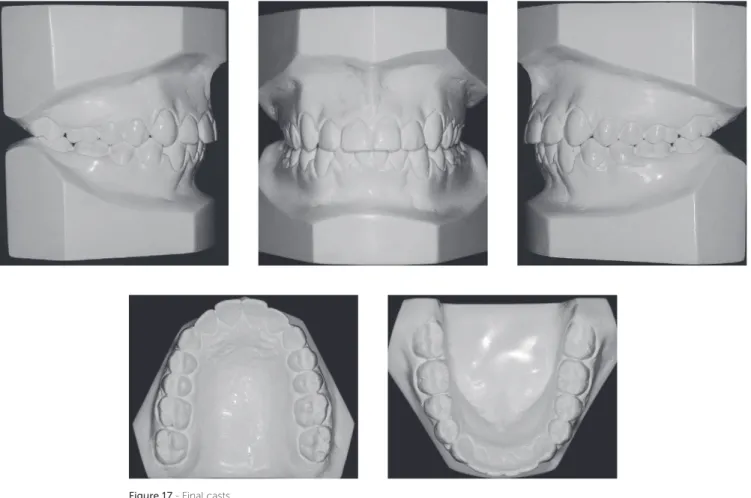 Figure 17 - Final casts.