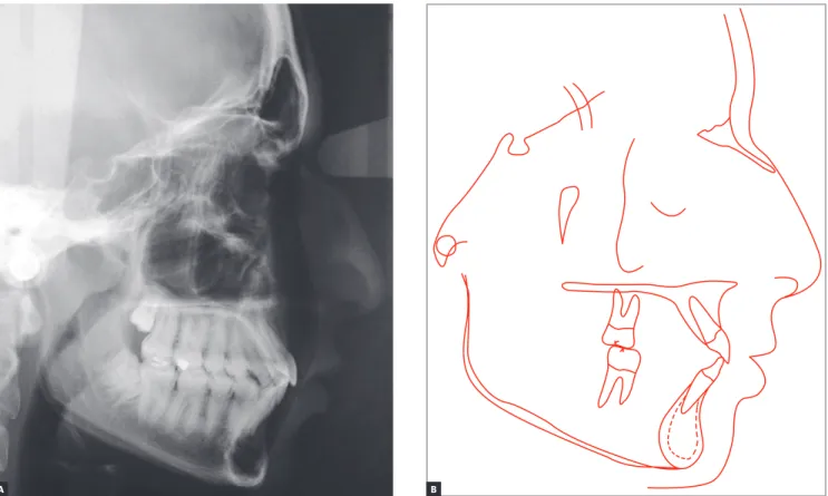 Figure 19 - Final cephalometric profile radiograph (A) and cephalometric tracing (B).