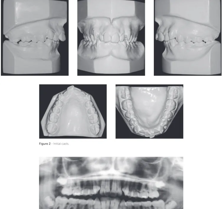 Figure 2 - Initial casts.