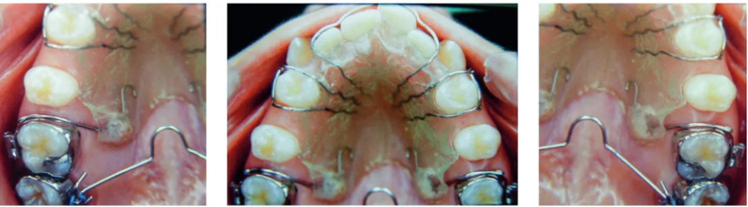 Figure 8 - Removable plate on first molars associated with transpalatal bar on second molars.