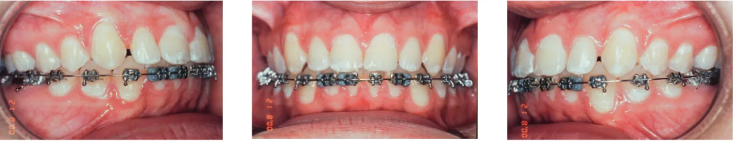 Figure 15 - Bolton discrepancy, remaining spaces will be used to improve shape and increase mesiodistal diameter of teeth #12 and #22.