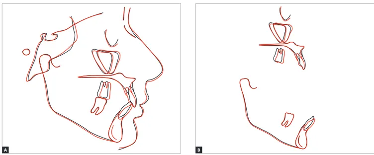 Figure 18 - Superimposition of initial (black) and final (red) tracings.