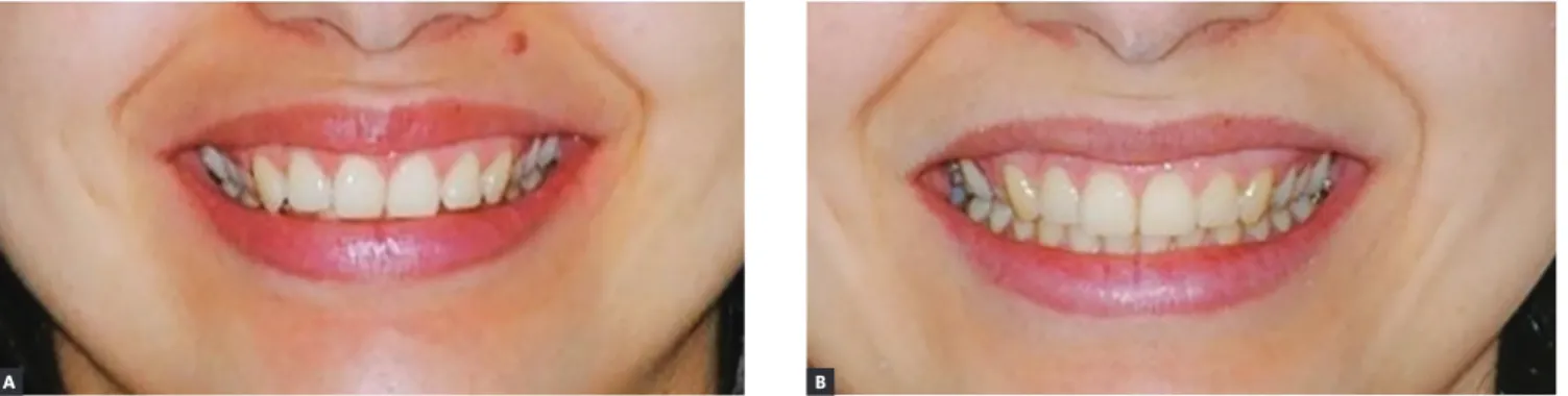 Figure 21 - Close-up photographs of patient's smile: pre- (A) and post-treatment (B).