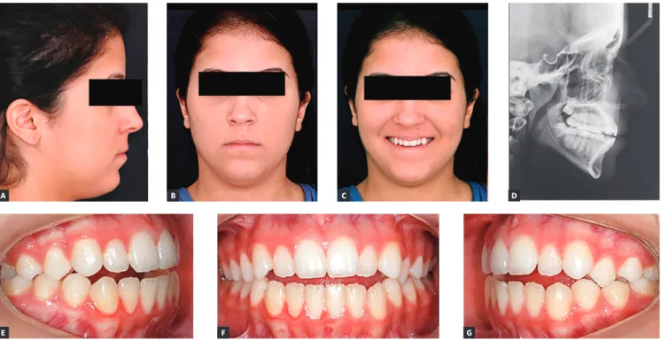 Figure 4 - Maxillary incisors touching (0 mm) the FAOP. Ideally, they should  be 2 to 4 mm below the FAOP