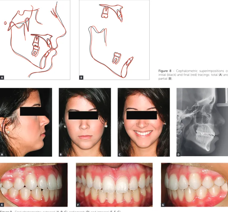 Figure 8 - Cephalometric superimpositions of  initial (black) and final (red) tracings: total (A) and  partial (B).