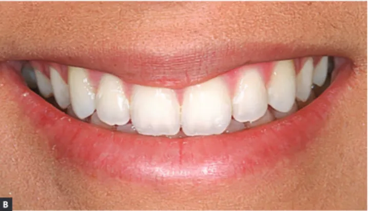 Figure 11 - Smile photographs: before (A) and after (B) treatment.