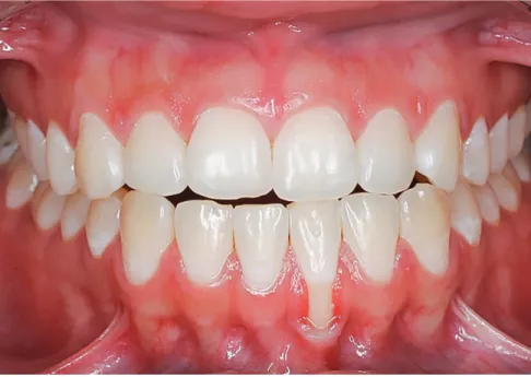 Figure 10 - In the same clinical case presented  in Figure 9, local gingival recession is  associ-ated with dental plaque and severe occlusal  interference