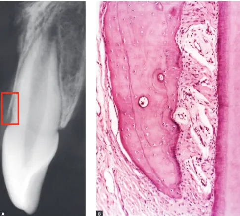Figure 1 - Radiographic image reveals the struc- struc-tural fragility of human buccal bone plate in  the region of maxillary incisors, in addition to  its dimensional relationship with the  periodon-tal space and the mineralized tooth structures
