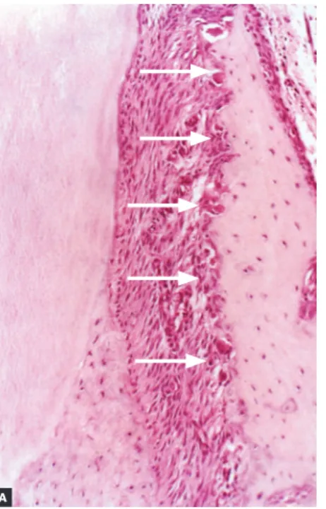 Figure 8 - Under orthodontic movement con- con-ditions, with balanced load distribution, frontal  bone resorption (white arrows) is compensated  by deposition of new bone layers on the buccal  surface of the buccal bone plate by the  perios-teum (red arrow