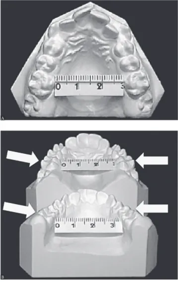 Figure 2 - Diagnosing transverse discrepancy: pretreatment casts of a  12-year-old patient