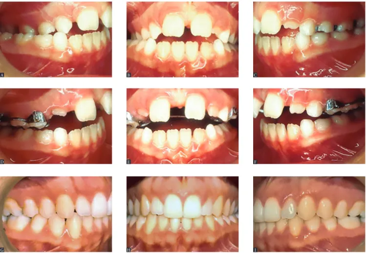 Figure 4 - Intraoral photographs: right lateral, central, and left lateral views at pretreatment (A, B and C), post expansion (D, E and F), and post-treatment (G, H and I)