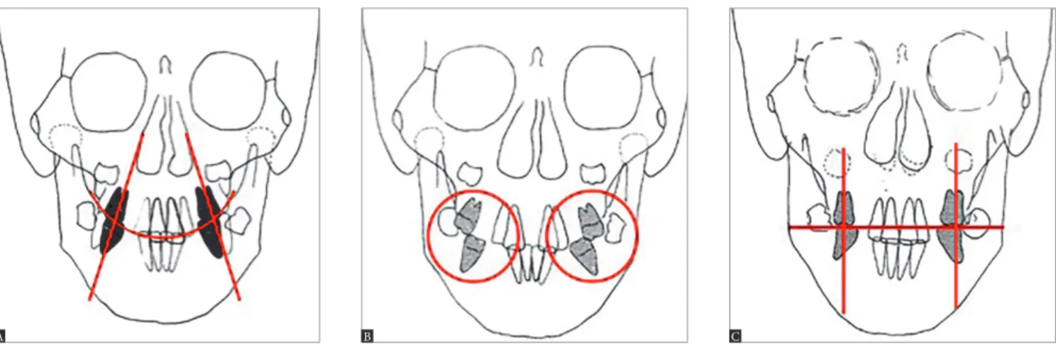 Figure 7 - Skeletal Class II, Division 1 malocclusion patient during mixed dentition: Posteroanterior tracings