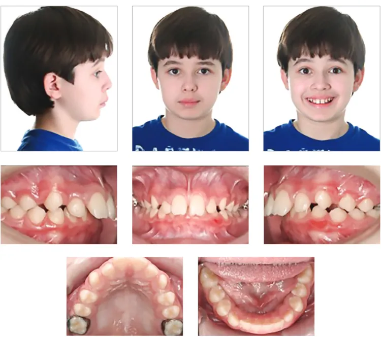 Figure 9 - Note Class II molar correction with transseptal fibers producing significant improvement in the  buccal segment with bicuspids assuming a solid Class I occlusion.