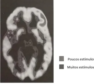Figura 1 – TC a um cérebro com muitos estímulos Figura 2 – TC a um cérebro com poucos estímulos 