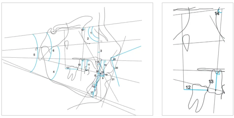 Figure 3 - Cephalometric variables: 1) SNA, 2) SNB, 3) ANB, 4) FMA, 5) SN.GoGn, 6) SN.Ocl, 7) LAFH,  8)  U1.NA,  9) U1-NA, 10) U1-PP, 11) U5-PP, 12) U6-PTV, 13) U6-PP, 14) U6.SN, 15) L1.NB, 16) L1-NB,  17) L1-GoGn, 18) Overjet, 19) Overbite, 20) UL-E, 21) 