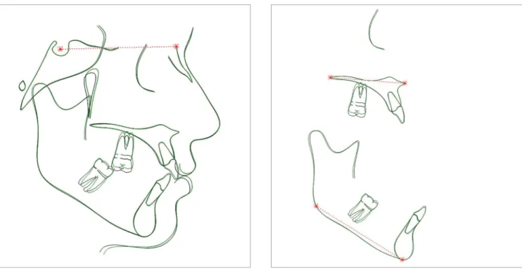 Figure 5 - Initial and final average tracings superimposition of Group 1.