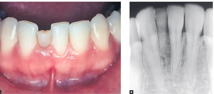 Figure 2 - Deciduous tooth found in and adult patient’s mouth, revealing infraocclusion and tooth root with preserved structure, but also revealing irregular areas  of surface resorption, with imprecise lamina dura delimitation and periodontal space.