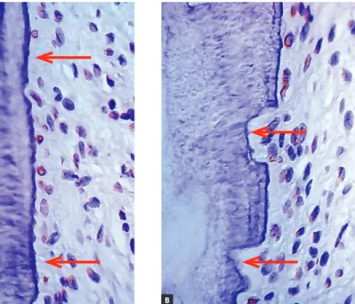 Figure 4 - Root surface and periodontal liga- liga-ment of a human deciduous tooth  immunohis-tochemically marked to reveal cementoblasts  under apoptosis (TUNEL method) already  ab-sent in a few regions (arrows) where root  re-sorption has already been in