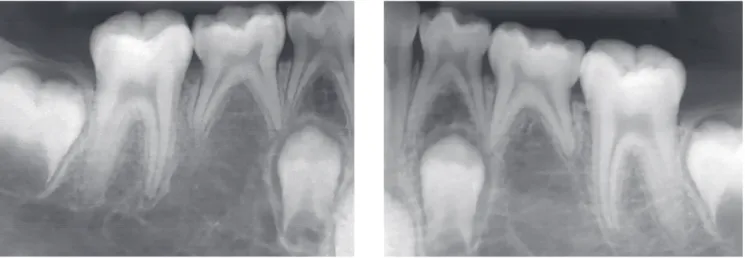 Figure 5 - Deciduous molars in a patient with partial anodontia of second premolars. At this stage, the case must be well planned with a combination of knowl- knowl-edge and experience shared by pediatric dentists, implant dentists and orthodontists, witho