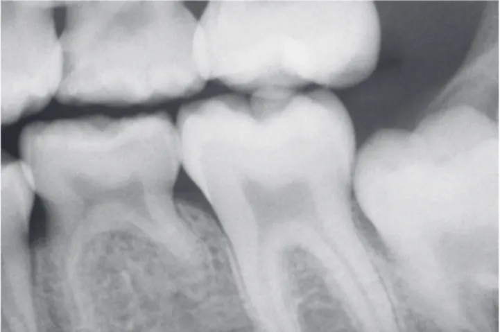 Figure 7 - Adult deciduous tooth with replacement tooth resorption after  alveolodental ankylosis.
