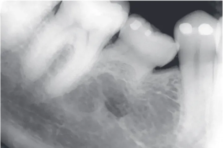 Figure 10 - Adult deciduous teeth infraocclusion and size discrepancy  among permanent and deciduous teeth lead to displacement and irregular  space closure, with tipping of neighboring teeth and occlusal interference