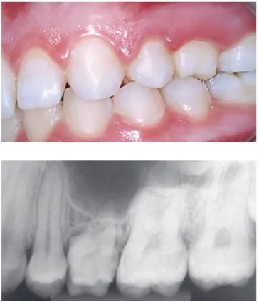 Figure 11 - Occasionally, and in a special manner, some cases of adult de- de-ciduous teeth are temporarily solved with wear and movement of teeth into  the space aimed at their permanent successor