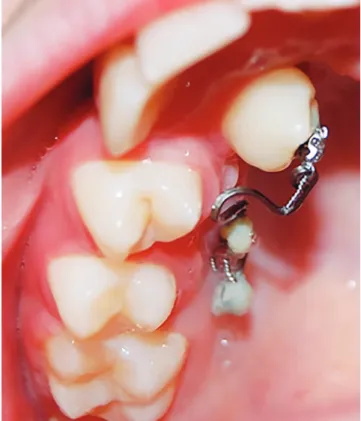 Figure 2 - Miniscrews were inserted mesial and distal to the maxillary second  premolar.