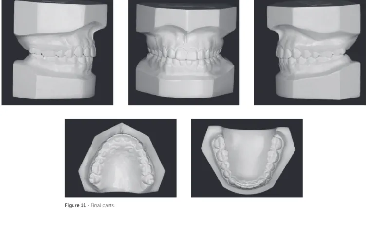 Figure 11 - Final casts.