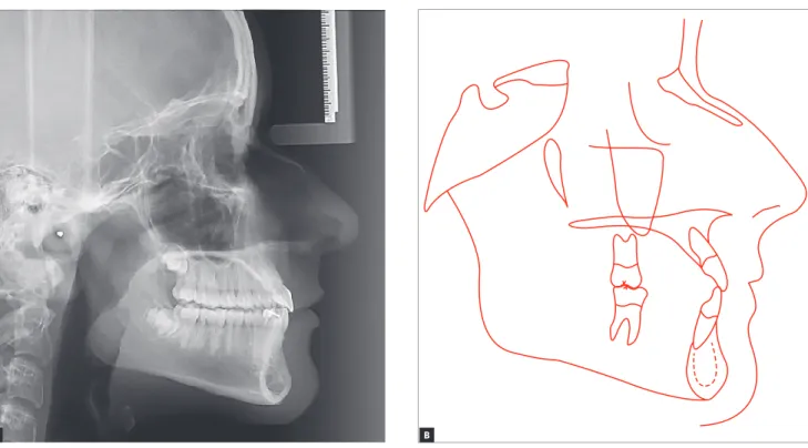 Figure 13 - Final lateral cephalogram (A) and cephalometric tracing (B).