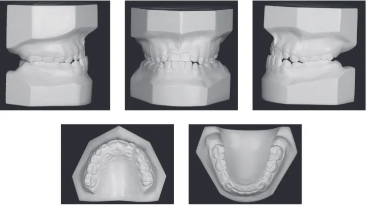 Figure 2 - Initial casts.